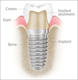 implant-illustration What exactly is a dental implant and who needs it?