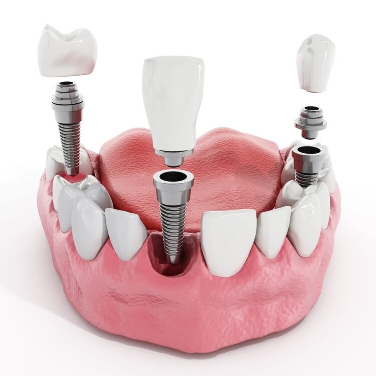 Proper Cleaning & Maintenance For Dental Implants