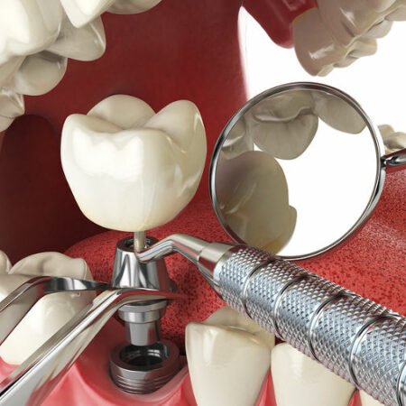 7 Amazing Truths About Dental Implants