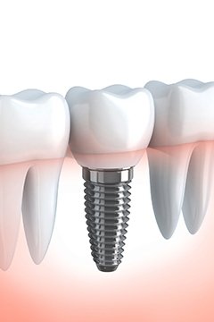 3 Dental Implant Options At Smile Store Cork & How They Work