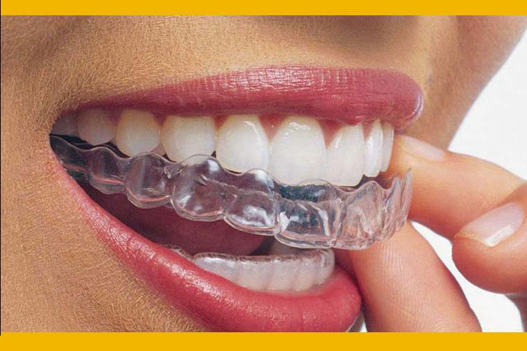 invisalign-wireless-braces