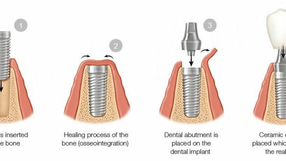 Getting Your Smile Back With Dental Implants