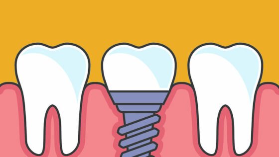 Tooth Loss After An Accident