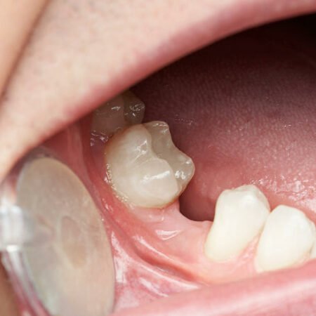 replace tooth after accident with dental implants