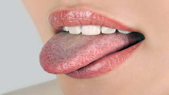 Bacteria living on your Tongue: How to Get Rid!