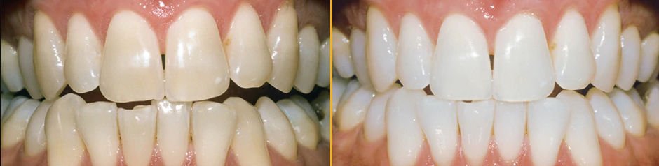 Before and after teeth whitening in Cork