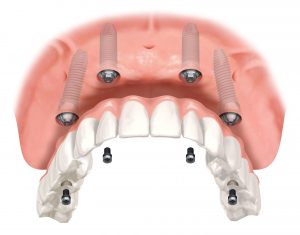 Dental implant bridge