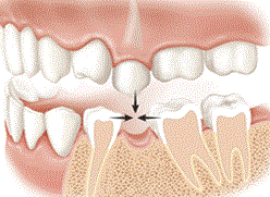 Replacing a single tooth