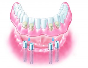 Implant supported denture